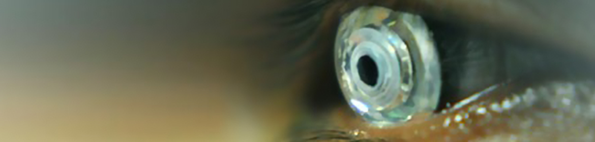 Telescopic contact lens