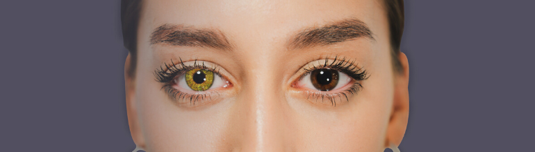 coloured contact lenses