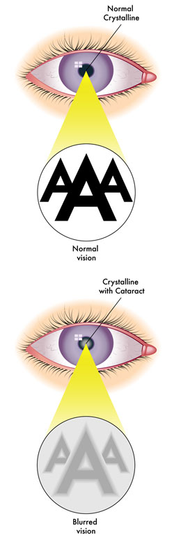Cataract diagram