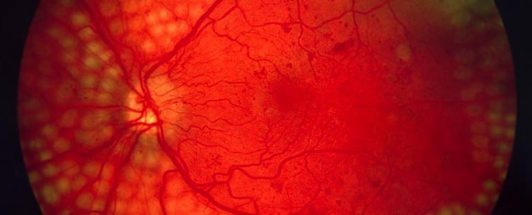 Image of retina