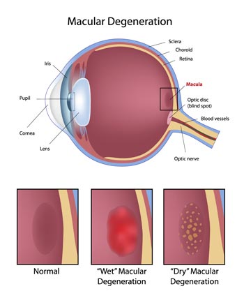 Macular Degeneration illustration