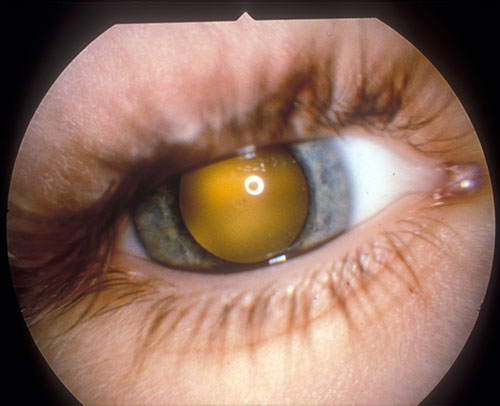 Cataract eye