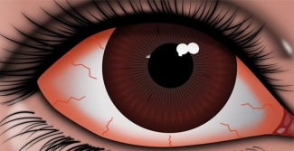 Illustration of a red eye
