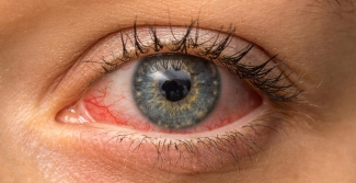 Download What causes bloodshot (red) eyes? | Lenstore.co.uk